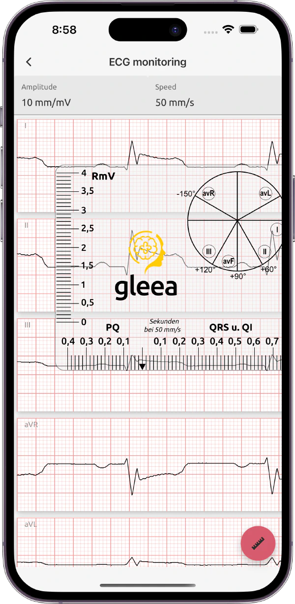 EKG